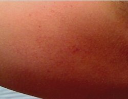 Bruise 2.jpg