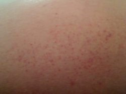 Bruise 3.jpg