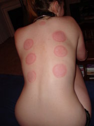 fire cupping.jpg