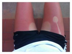 funny picnic sunburn.jpg