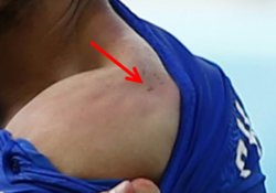 Chiellini bite mark.jpg