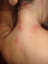 bed-bugs-bites1.jpg