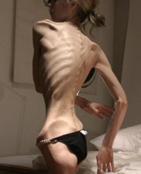 Anorexia.jpeg